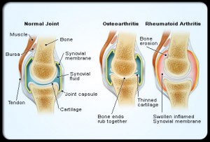 joint with osteoarthritis