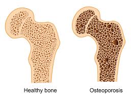 Bone density Osteoporosis
